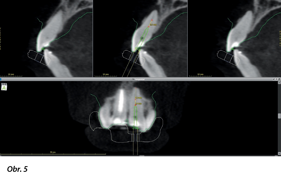 Virtuální plánování navigované endodoncie s coDiagnostiX.