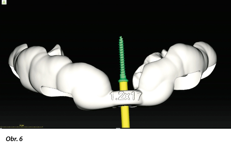 Virtuální kopie pozice vrtáčku (1,2 × 17 mm) ve 3D šabloně.