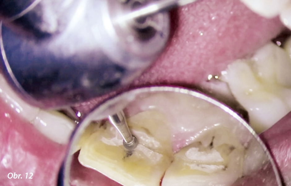 Odstranění skloviny diamantovým brouskem až k odhalení dentinu.