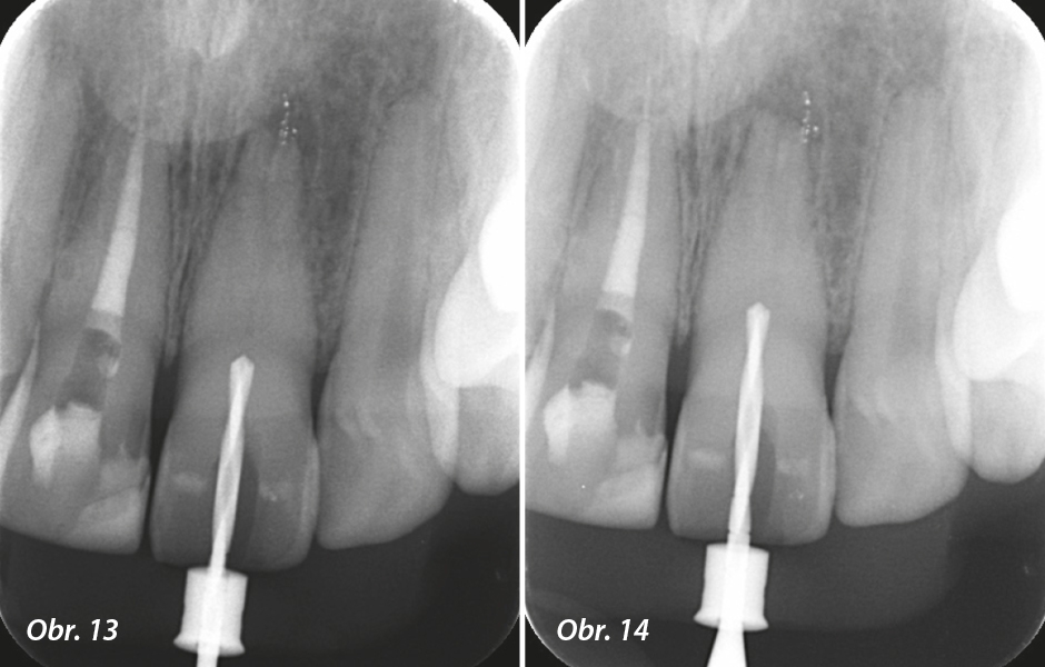 Radiografi cká kontrola pozice vrtáčku a jeho hloubky během výkonu.