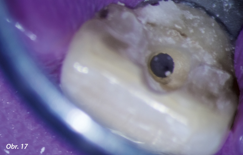 Pohled na endodontickou přístupovou kavitu po nalezení kořenového kanálku.