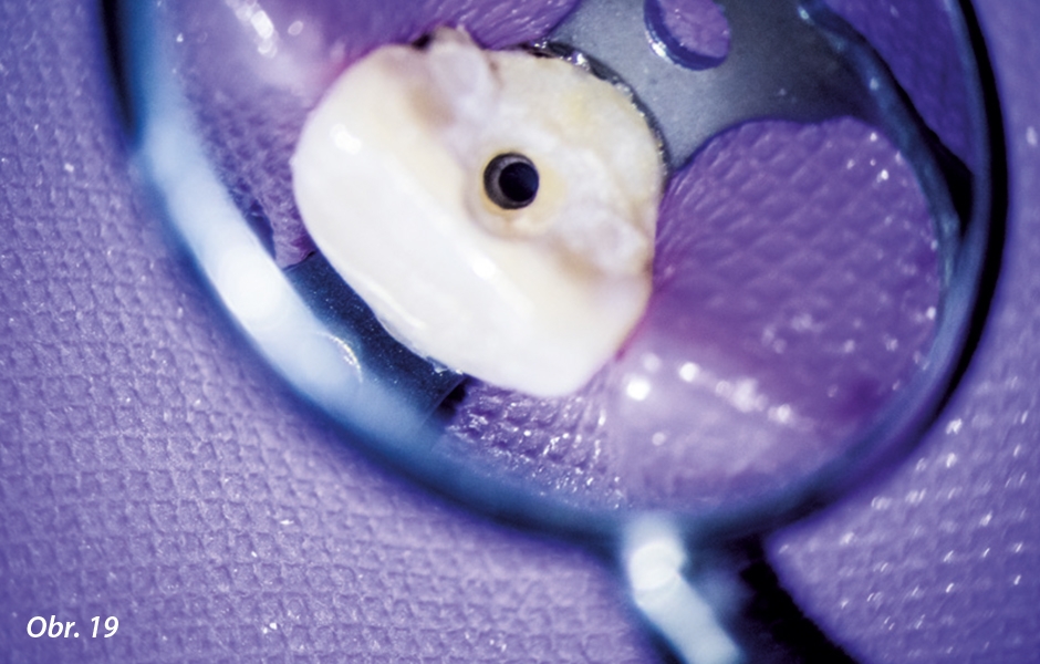 Pohled na endodontickou přístupovou kavitu po mechanickém opracování kořenového kanálku.