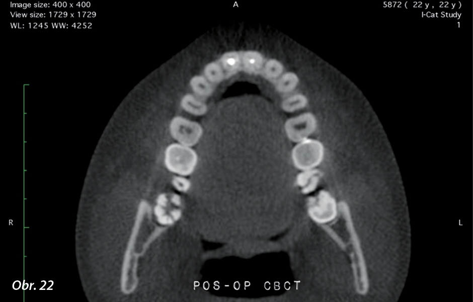 CBCT sken po ošetření kořenových kanálků z koronálního a sagitálního pohledu.