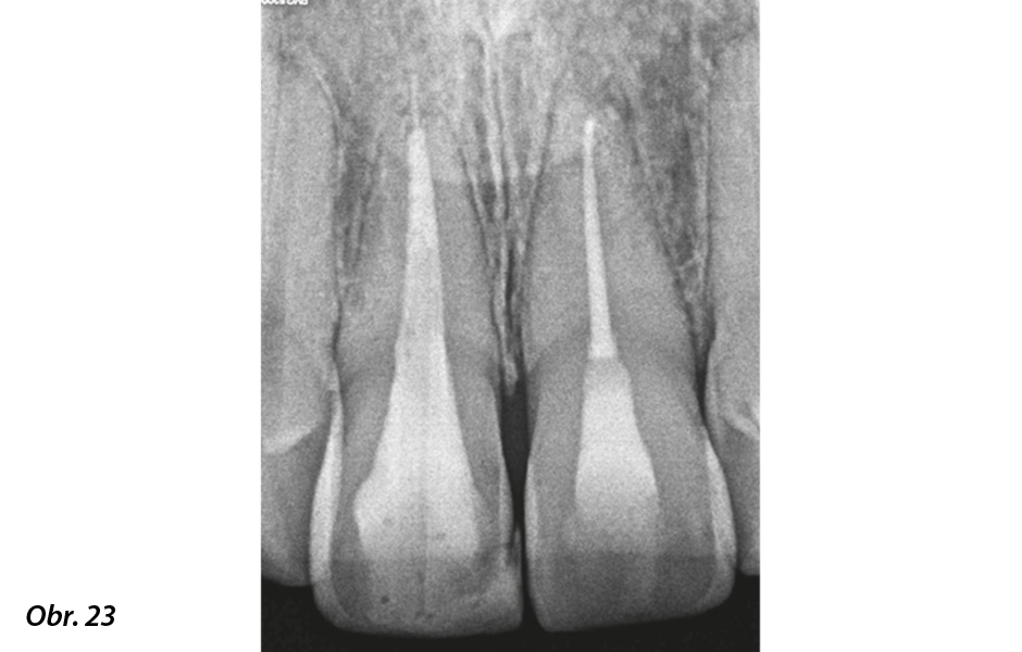 CBCT sken po ošetření kořenových kanálků z koronálního a sagitálního pohledu.