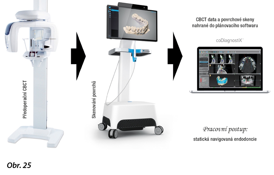 Diagram s pracovním postupem pro statický navigovaný endodontický přístup