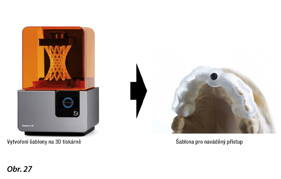 Diagram s pracovním postupem pro statický navigovaný endodontický přístup