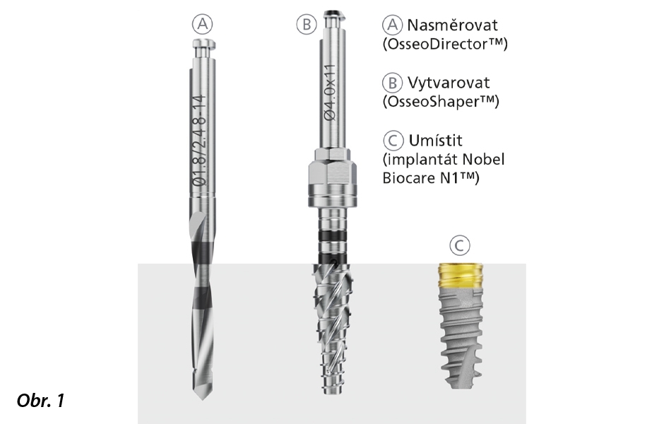 Ve většině případů zahrnuje preparace lůžka implantátu při použití systému implantátů N1™ pouze dva chirurgické kroky: vytvoření hloubky a sklonu osteotomie pomocí OsseoDirector™ a poté vytvarování osteotomie pomocí OsseoShaper™.