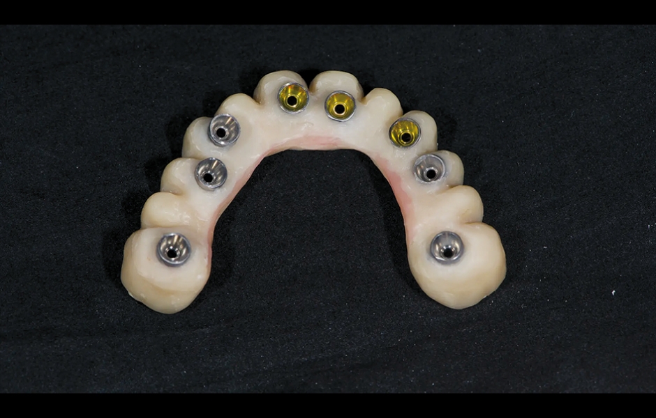 Obr. 10: Provizorní protetická práce s kovovou výztuhou.