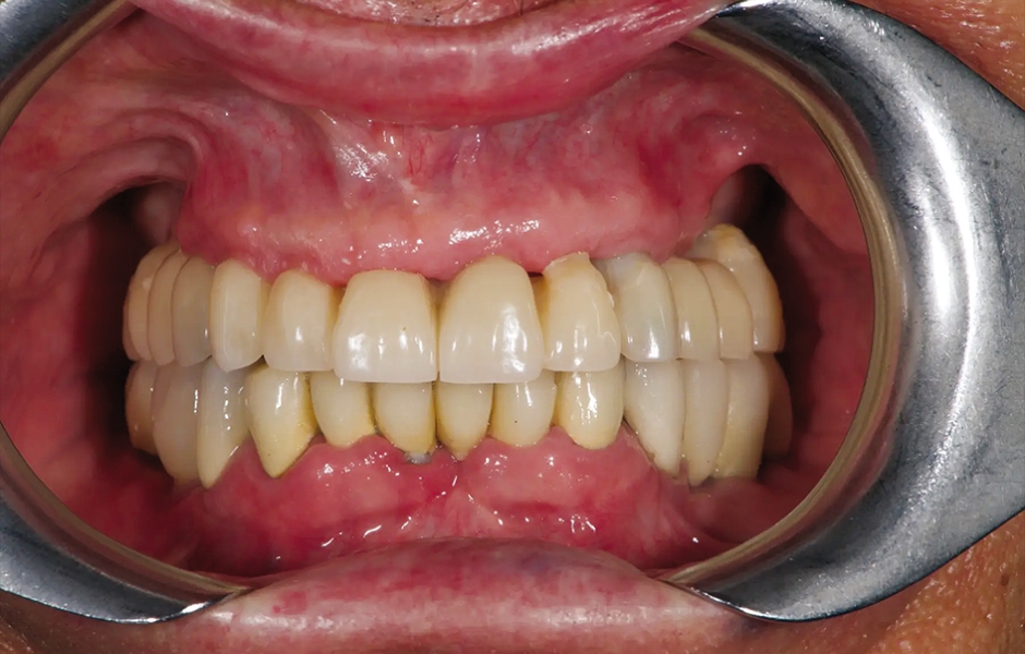 Obr. 11: Provizorní protetická práce s kovovou výztuhou in situ, čelní pohled.