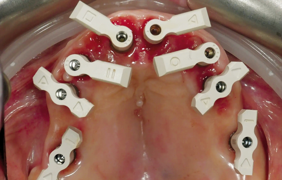 Obr. 13: Scan body SmartFlag nasazené pro intraorální otisk.