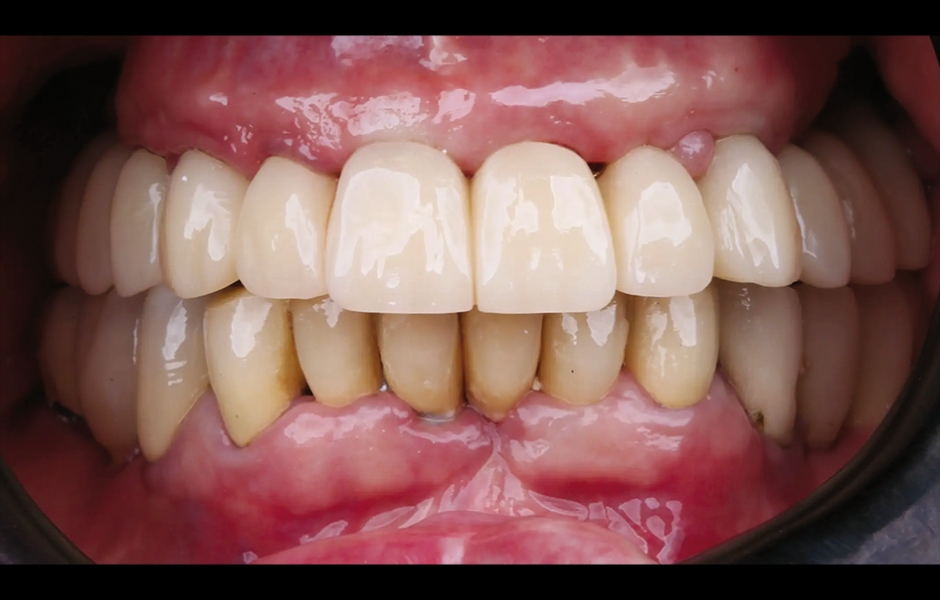 Obr. 16: PMMA prototyp pro ověření funkce a estetiky.