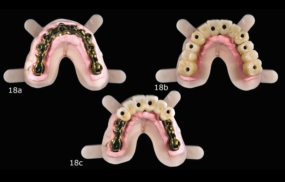 Obr. 18a–c: Hybridní definitivní práce tvořená CAD/CAM titanovou výztuží a třemi zirkoniovými protetickými segmenty fixovanými shora.