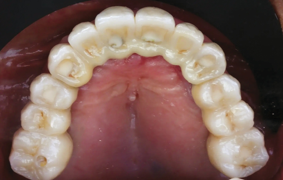 Obr. 20: Definitivní protetická práce při jednoroční kontrole, okluzální pohled.