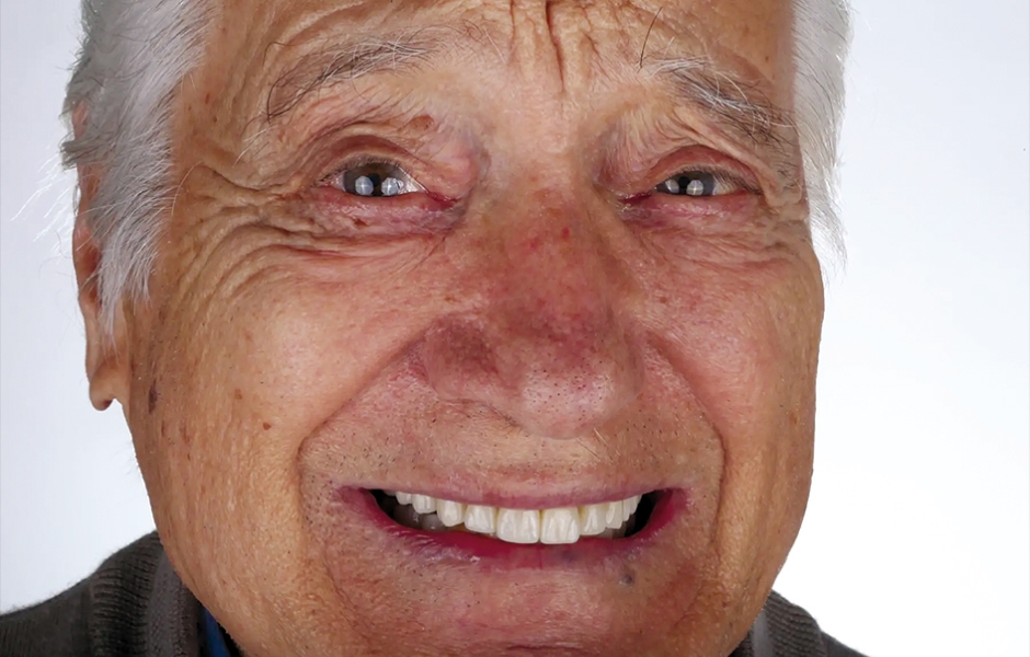 Obr. 21: Jednoroční kontrola, faciální pohled.