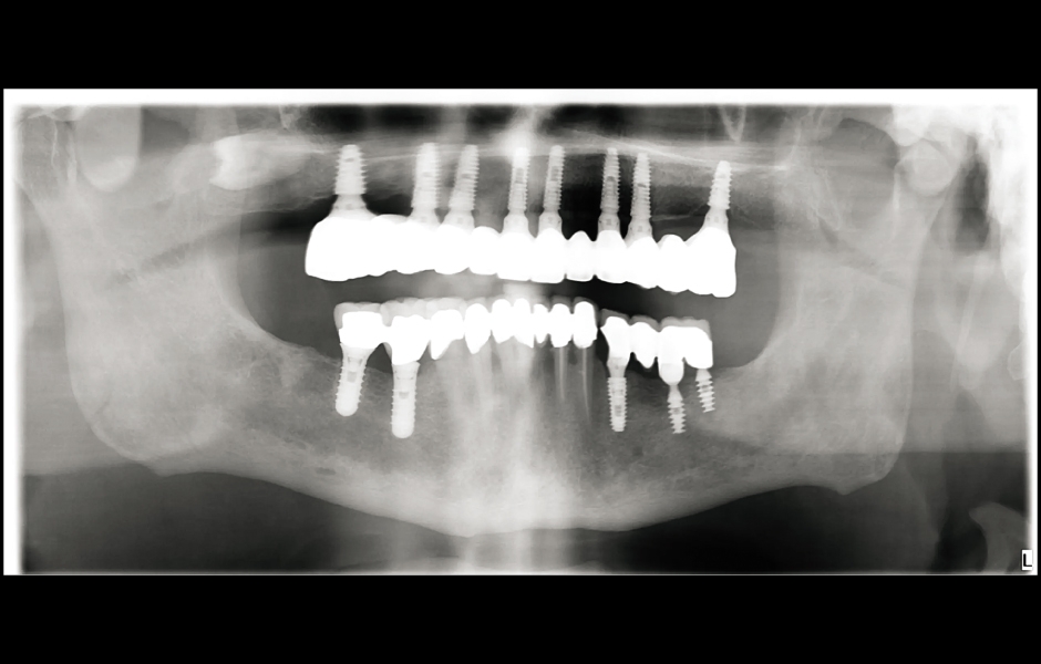 Obr. 22: Panoramatický rentgenový snímek chrupu po jednom roce.