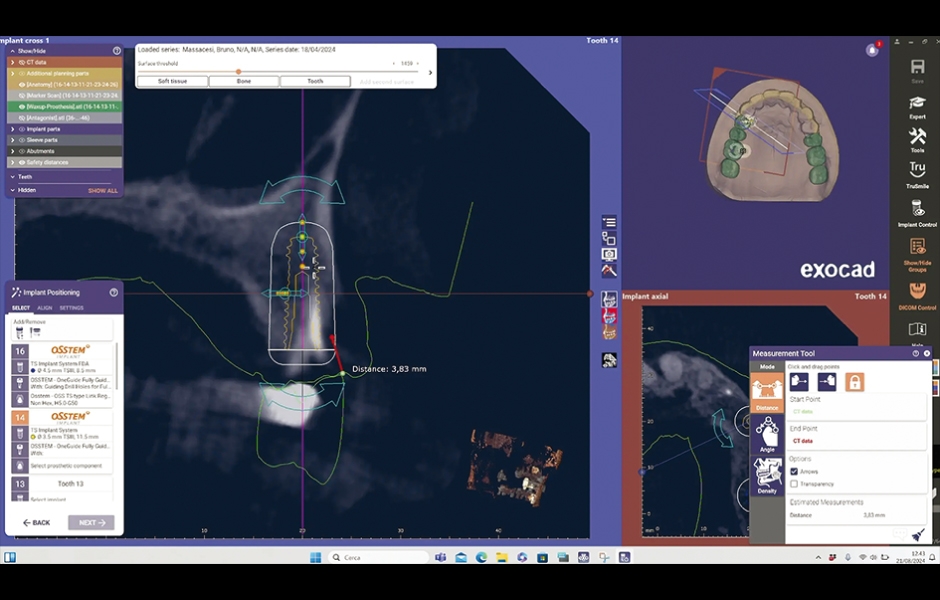 Obr. 4: Virtuální plánování implantátu do okamžité postextrakční oblasti v exoplan 3.1.