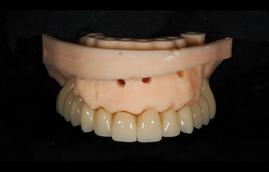 Obr. 5: Předem zhotovená provizorní protetická práce z PMMA.