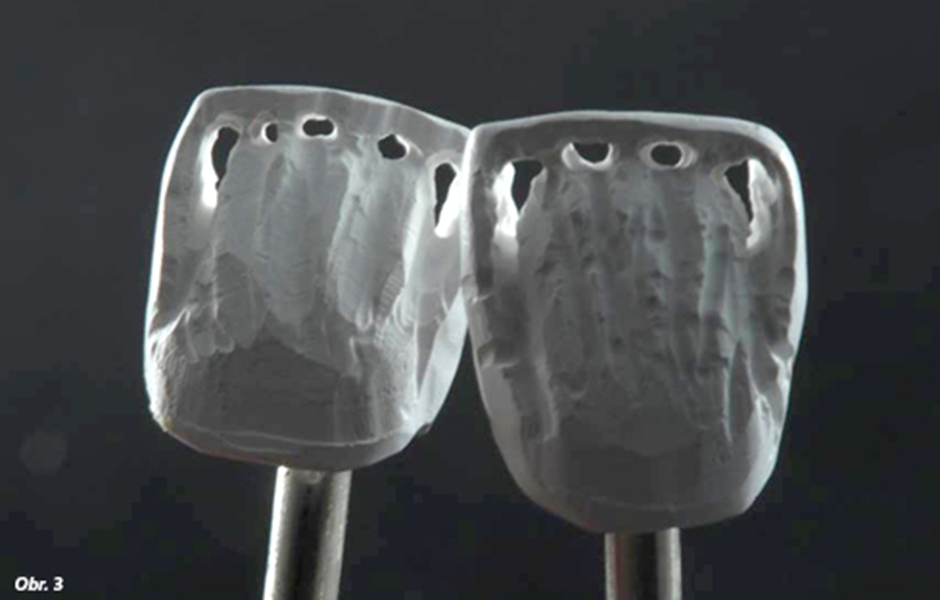 Perforace zhotovené ručně prostřednictvím finýrovacího vrtáčku v surové fázi konstrukce pro definování translucentních míst, která odpovídají místům na přirozených sousedních zubech