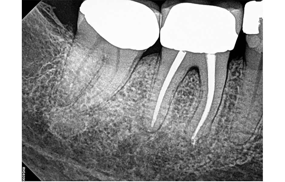 Obr. 4: Kontrola po 6 měsících: periapikální rentgenový snímek zubu 46 z ledna 2023 ukazuje významné apikální hojení; úplné zhojení se očekává během následujících 3–6 měsíců.
