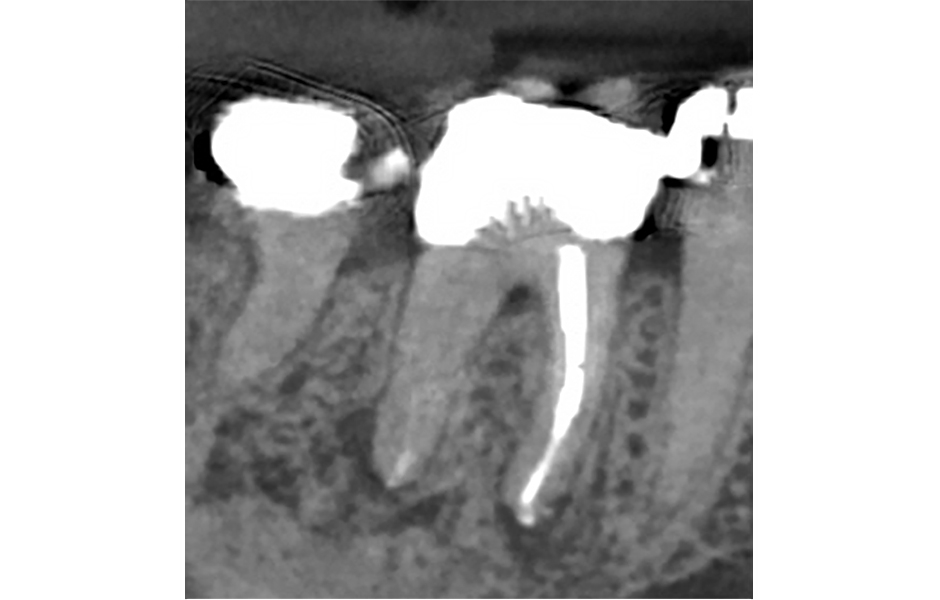 Obr. 5: Kontrola po 6 měsících: CBCT axiální snímek zubu 46 z ledna 2023 ukazuje významné apikální hojení; úplné zhojení se očekává během následujících 3–6 měsíců.