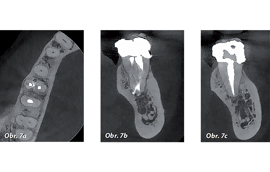 Obr. 7a–c: Kontrolní CBCT řezy zubu 46 – a) axiální, b) meziální kořen, c) distální kořen.