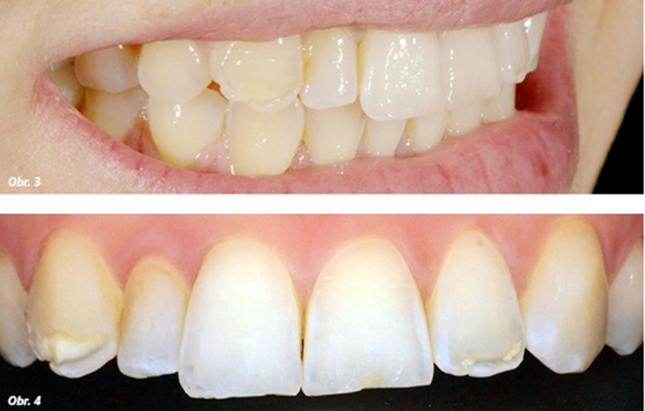 Obr. 3: U pacientky byla zřejmá ztráta tvrdých zubních tkání vestibulárně s odhaleným dentinem, Obr. 4: Pro výběr barvy byl zhotoven křížově polarizovaný snímek