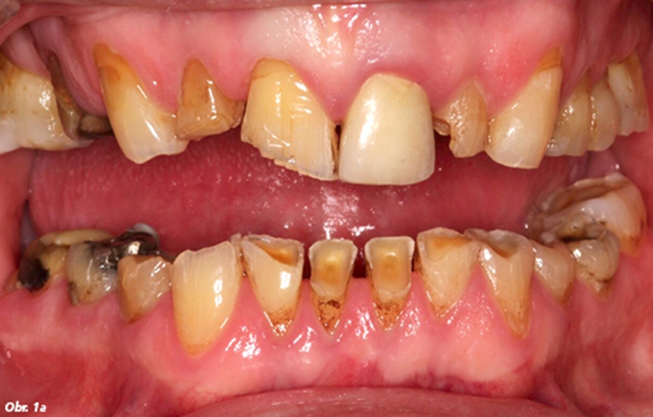 Frontální pohled zobrazující opotřebovanou dentici se sníženou výškou skusu
