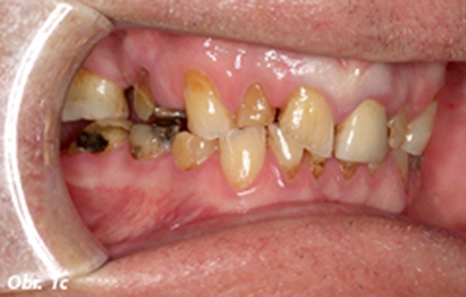 Laterální pohled zobrazující opotřebovanou dentici se sníženou výškou skusu