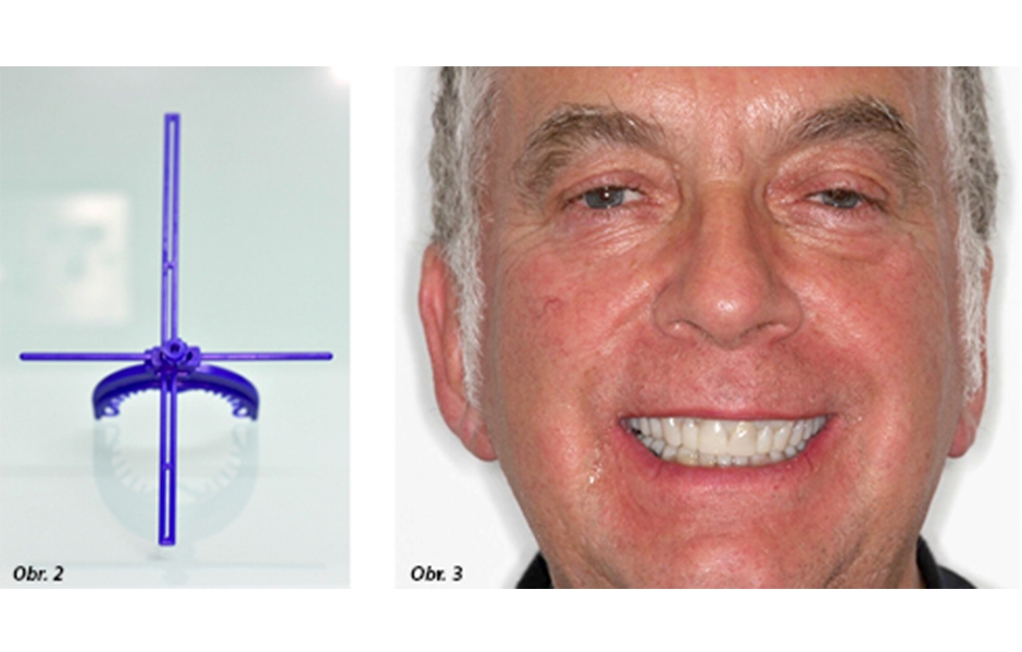 Obr. 2: Předběžně určená střední čára a horizontální rovina byly kalibrovány pomocí Crossref, Obr. 3: Předběžný náhled výsledku bylo možné vizualizovat dočasným přenosem provizorních korunek přes preparované zuby z diagnostického wax-upu
