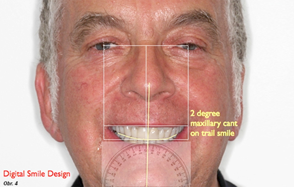 Záznam střední čáry a horizontální roviny za použití Trial Smile Analysis