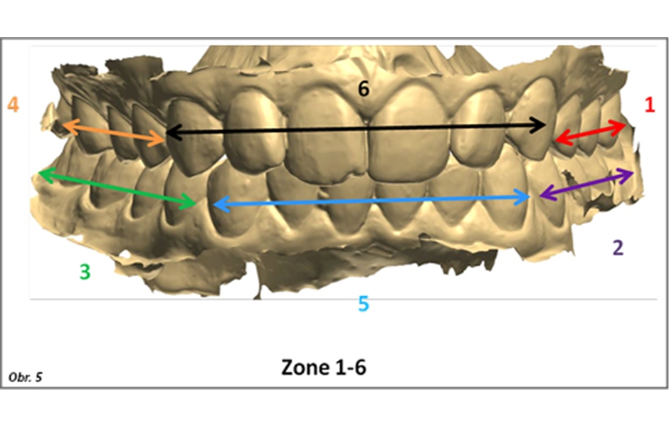 Šest zón preparace – vždy jen jedna zóna byla vyřazena z okluze, přičemž preparace v estetické zóně (zóna šest) byla zařazena na konec