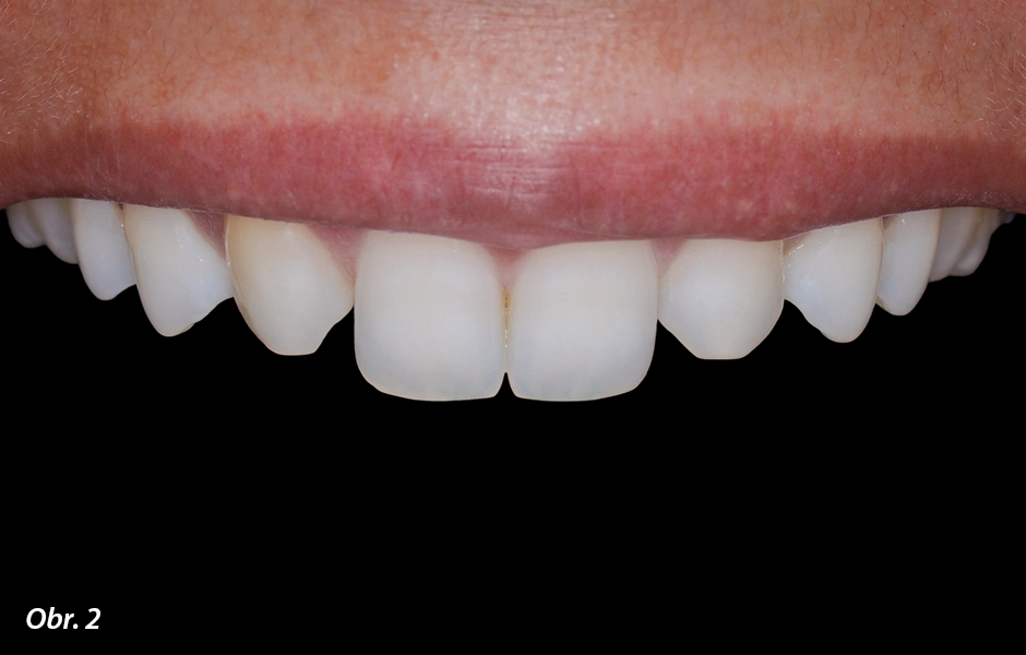 Počáteční stav – snímek horních frontálních zubů