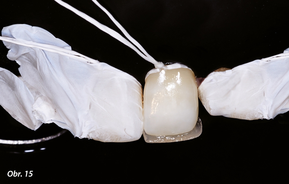Rekonstrukce incizní hrany zubu 22