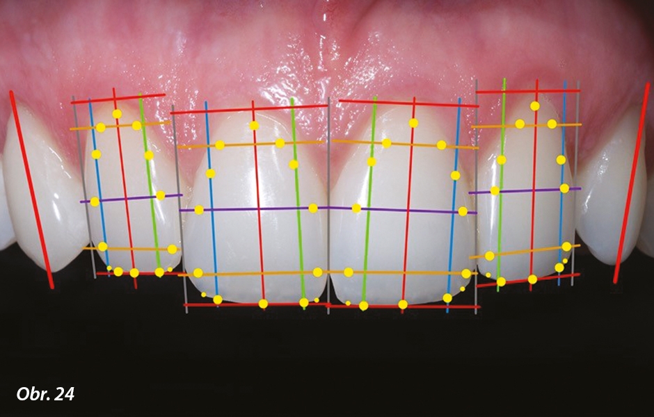 Podélné osy zubů zaznamenané formou mřížky…