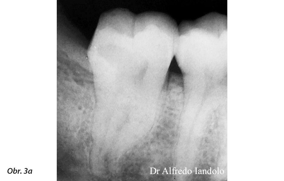 RTG snímek pacienta před a po ošetření se zřetelně viditelným obturačním materiálem v systému kořenových kanálků (fotografie zveřejněna se svolením Dr. Alfreda Iandaloa)