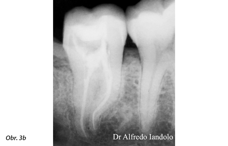 RTG snímek pacienta před a po ošetření se zřetelně viditelným obturačním materiálem v systému kořenových kanálků (fotografie zveřejněna se svolením Dr. Alfreda Iandaloa)