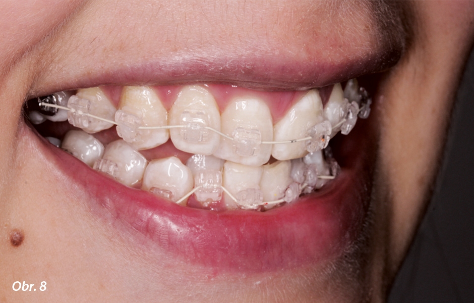 Ortodontická léčba byla dokončena řetízky působícími kontinuální silou pro uzavření všech zbytkových prostor