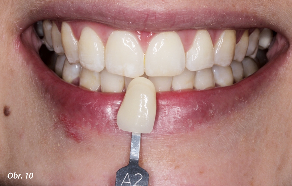Bělení zubů bylo prováděno přes noc po dobu dvou týdnů za použití 16% karbamid peroxidu