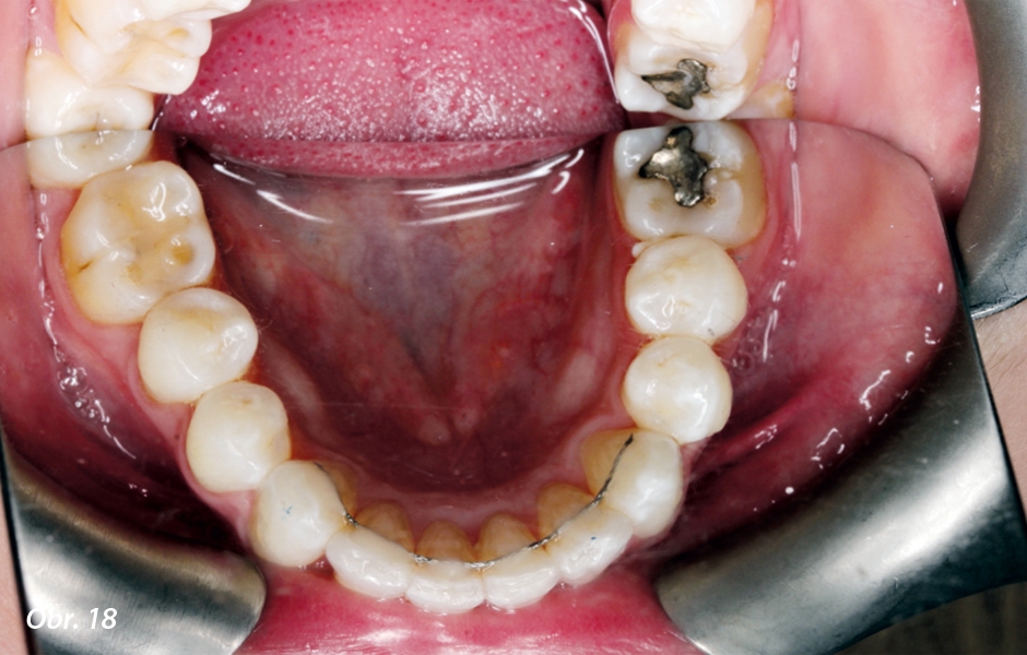 Ortodoncie trvala méně než pět měsíců a celý případ byl dokončen za šest měsíců