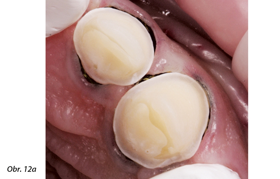 Adhezivní fixace rekonstrukcí na zuby v horní frontě