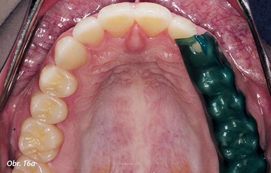 Kontrola dynamické okluze pomocí vosku Occlusal Indicator Wax