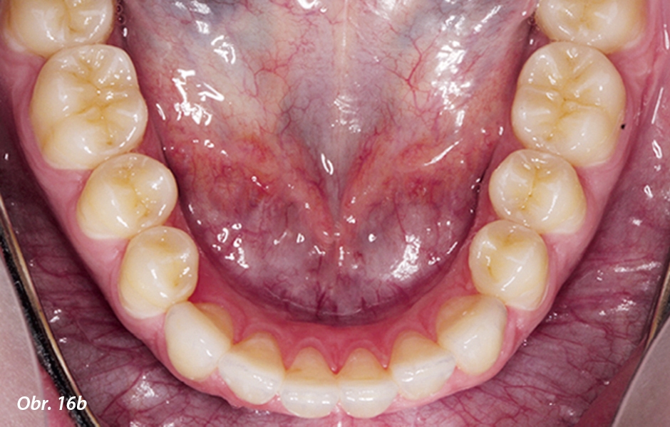 Kontrola dynamické okluze pomocí vosku Occlusal Indicator Wax