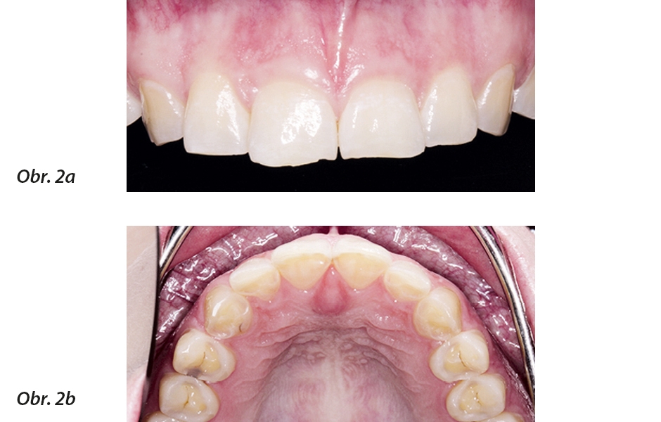 Počáteční situace: ztráta délky zubů a palatinální skloviny