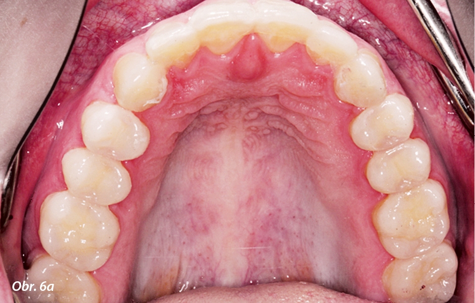 Horní a dolní fronta: prodloužení zubů kompozitem; horní postranní zuby s hotovými rekonstrukcemi