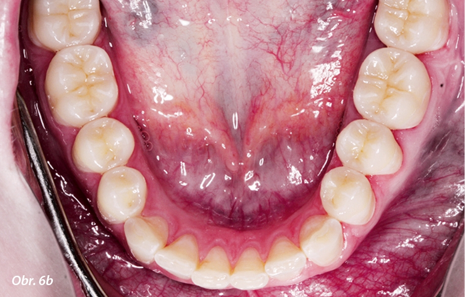 Horní a dolní fronta: prodloužení zubů kompozitem; dolní postranní zuby – definitivní částečné korunky (dobarvené)