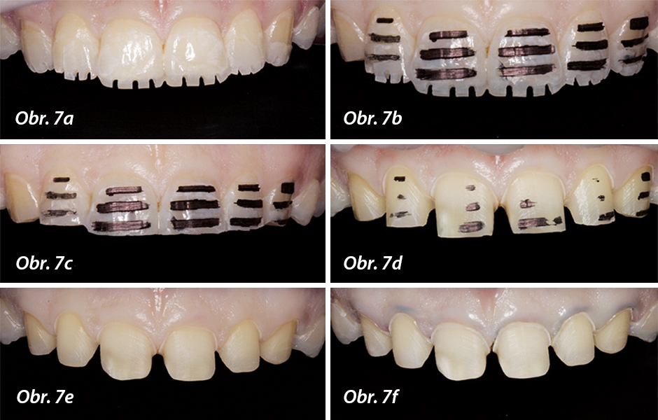 Jednotlivé kroky při minimálně invazivní preparaci horních frontálních zubů