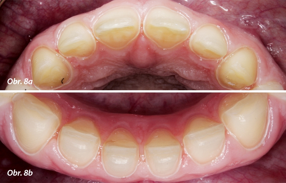 Hotová preparace frontálních zubů v horní a dolní čelisti