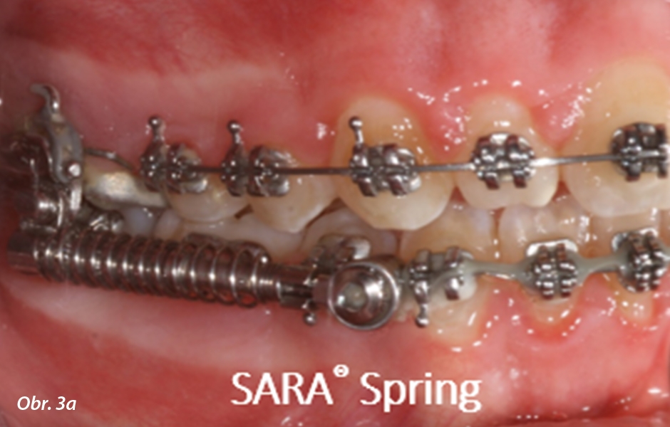 Moderní ortodoncie pro nespolupracující pacienty / „SARA® Concept“