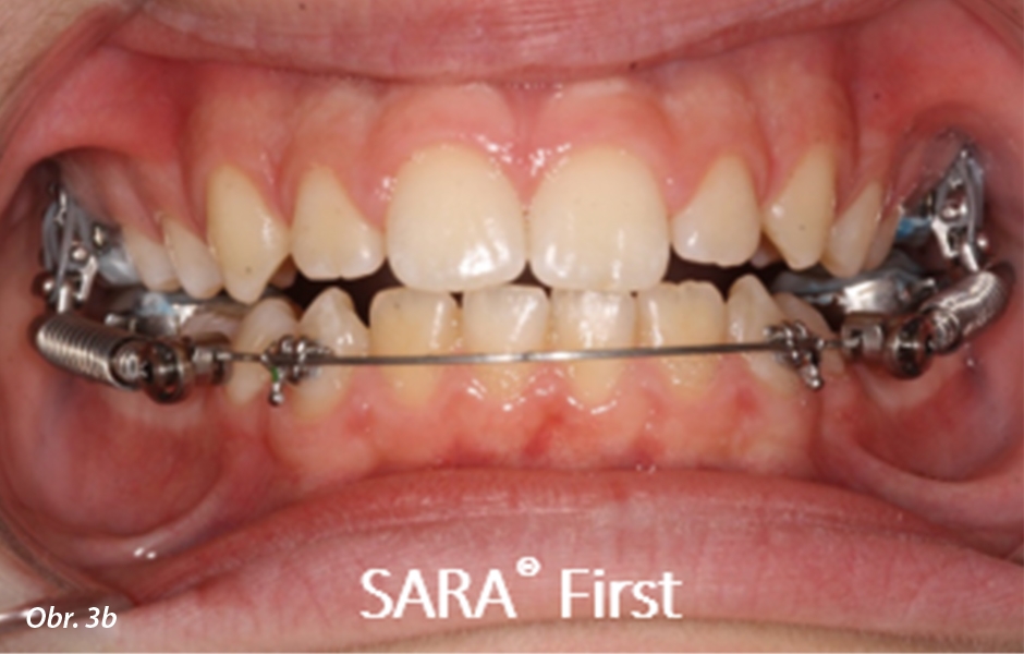 Moderní ortodoncie pro nespolupracující pacienty / „SARA® Concept“