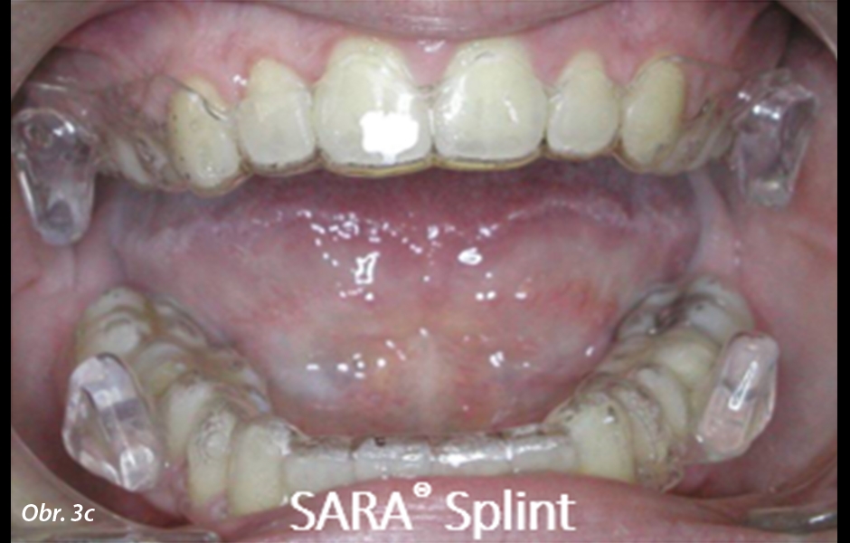 Moderní ortodoncie pro nespolupracující pacienty / „SARA® Concept“